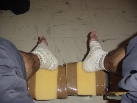 entorse des 2 cheville jpe plu marcher et jpe plu me tenir debout